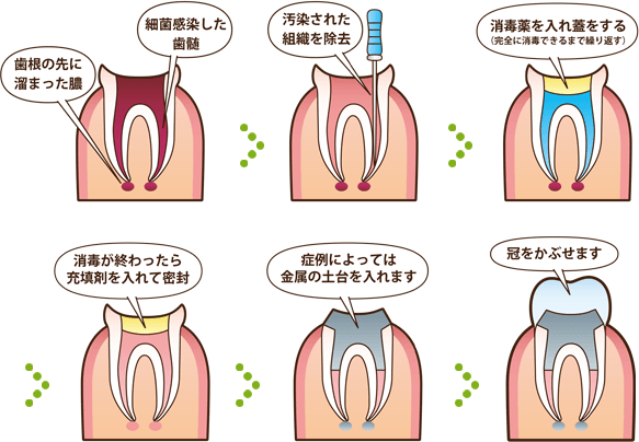 根管治療の流れ