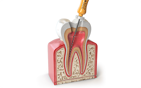 歯を残す根管治療について