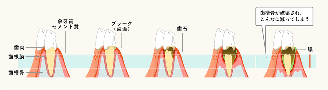 歯周病の進行