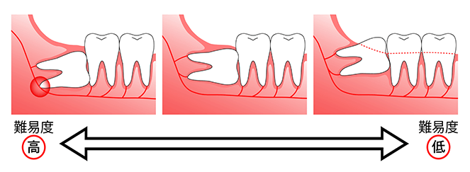 親知らずを抜いたほうが良い場合