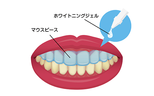 当院が取り扱うホワイトニングについて